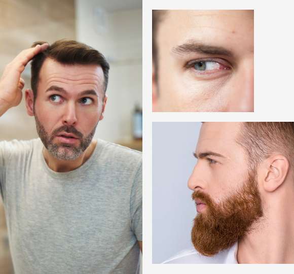 greffe capillaire en Belgique