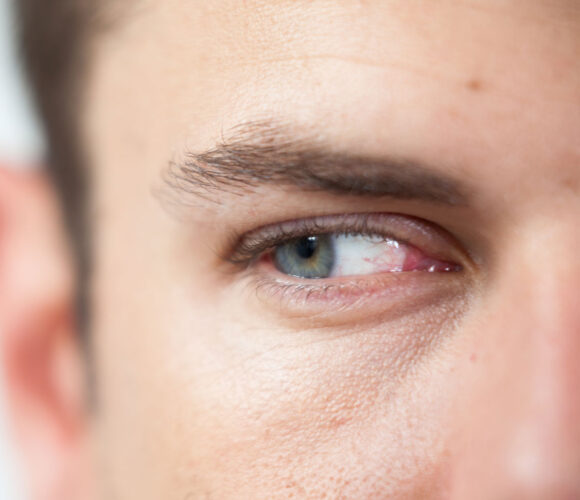 implant-sourcils-1 Greffe de sourcil