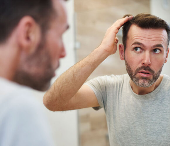 perte-de-cheveux-homme Greffe de cheveux